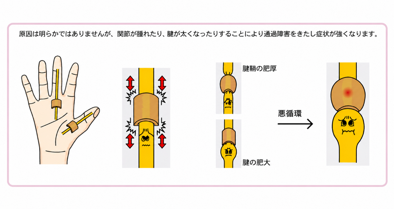 日帰り腱鞘切開手術