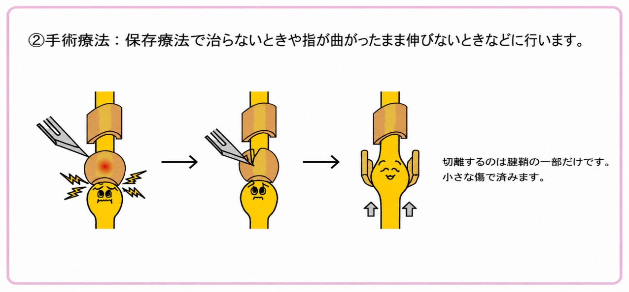 日帰り腱鞘切開手術のご案内